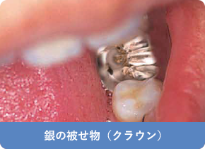 銀の被せ物（クラウン）